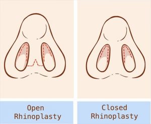 operasi hidung