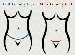 operasi perut tummy tuck