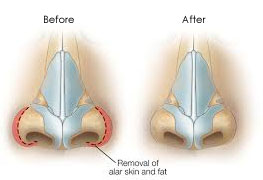 Merampingkan Cuping dengan Alarplasty